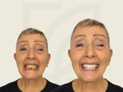 Dentalsem prima e dopo 3